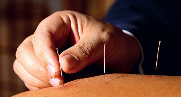 acupuncture